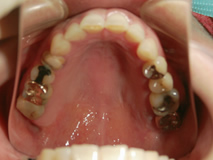 歯科治療症例 上顎