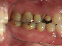 歯科治療症例 左上4番拡大