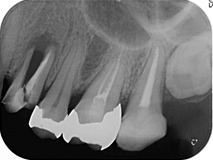 歯科治療症例レントゲン写真
