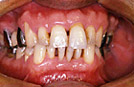 写真3における歯茎の状態の写真